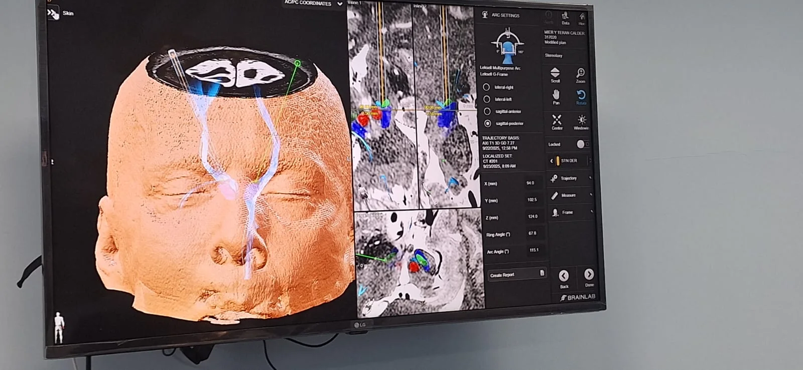 Planificación estereotáxica de estimulación cerebral profunda