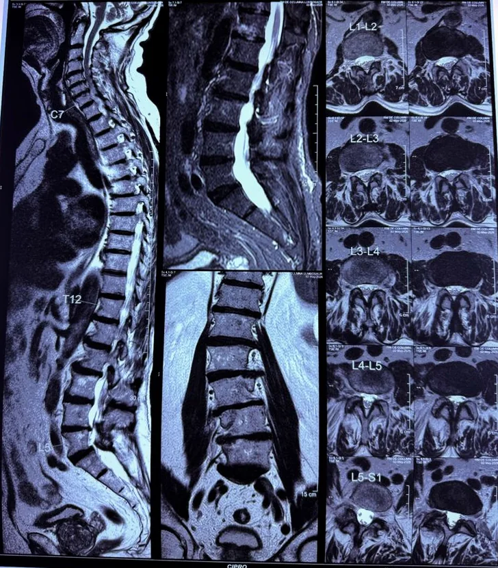 Estudio de resonancia de columna anonimizado
