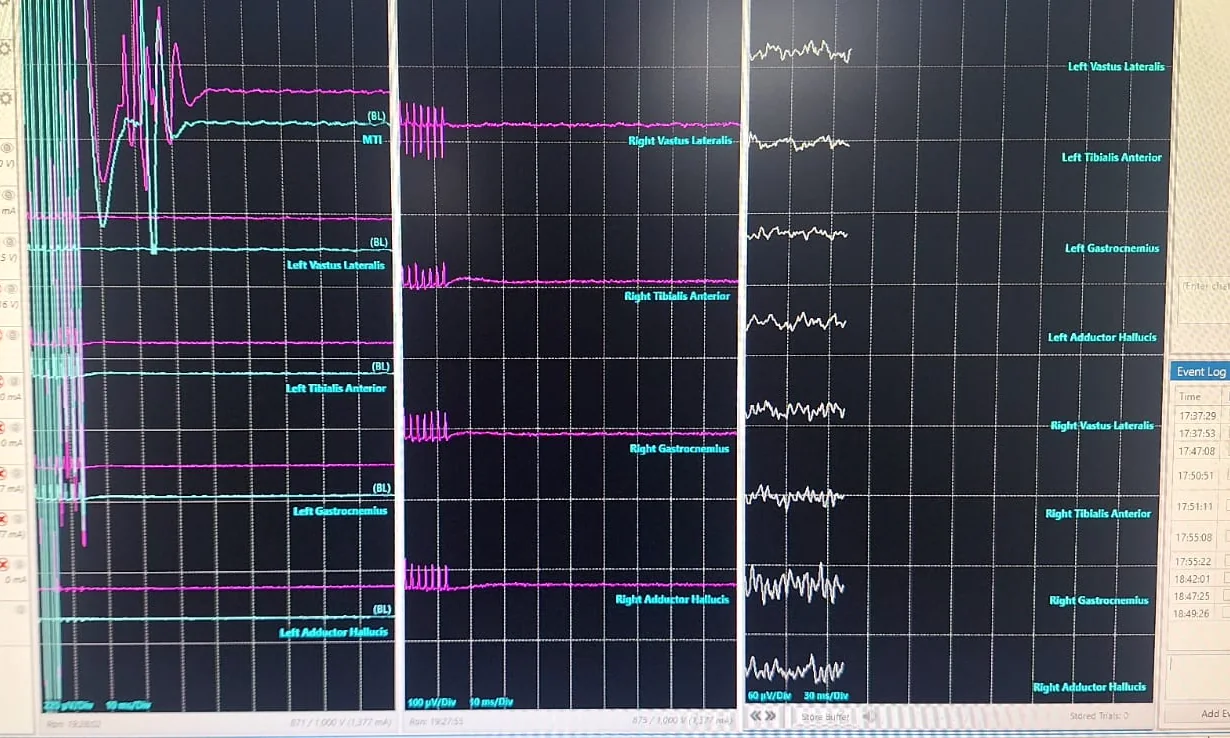 Potenciales evocados y electromiografía intraoperatoria