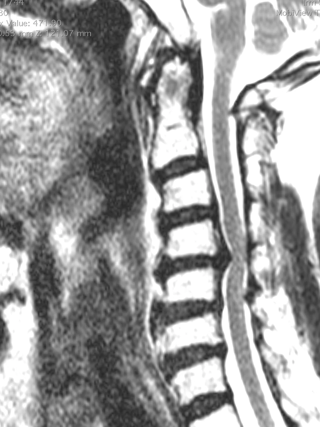 Resonancia cervical anonimizada