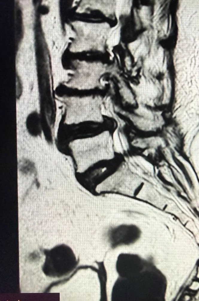 Resonancia lumbar anonimizada con cambios degenerativos