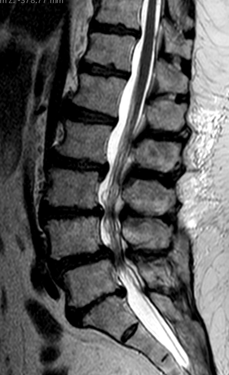 Resonancia lumbar anonimizada con estrechez del canal