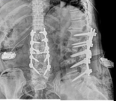 Radiografía de sistema de estimulación medular implantado
