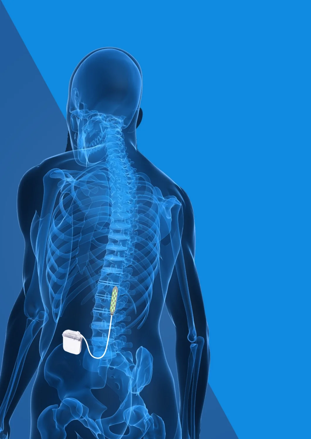 Esquema de sistema de estimulación espinal