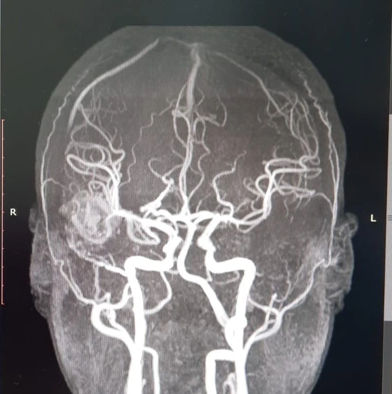 Angiografía cerebral de malformación vascular