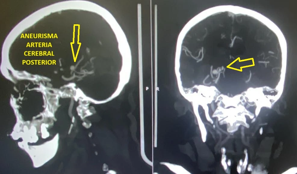 Angiotomografía cerebral utilizada en la evaluación de enfermedad vascular cerebral