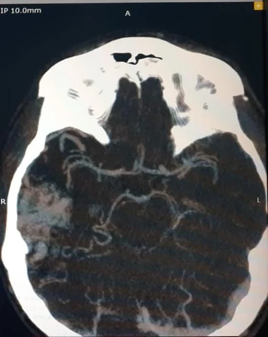 Angiotomografía cerebral para análisis vascular