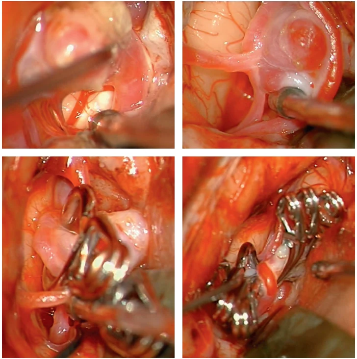 Secuencia microquirúrgica de clipaje de aneurisma cerebral
