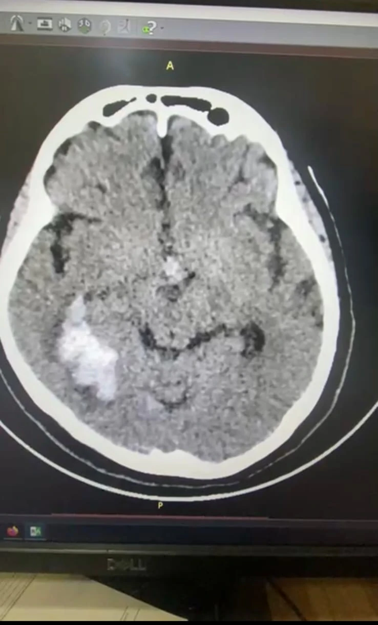 Tomografía con hemorragia cerebral