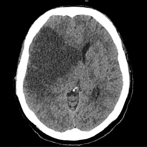 Tomografía cerebral utilizada en valoración neurovascular
