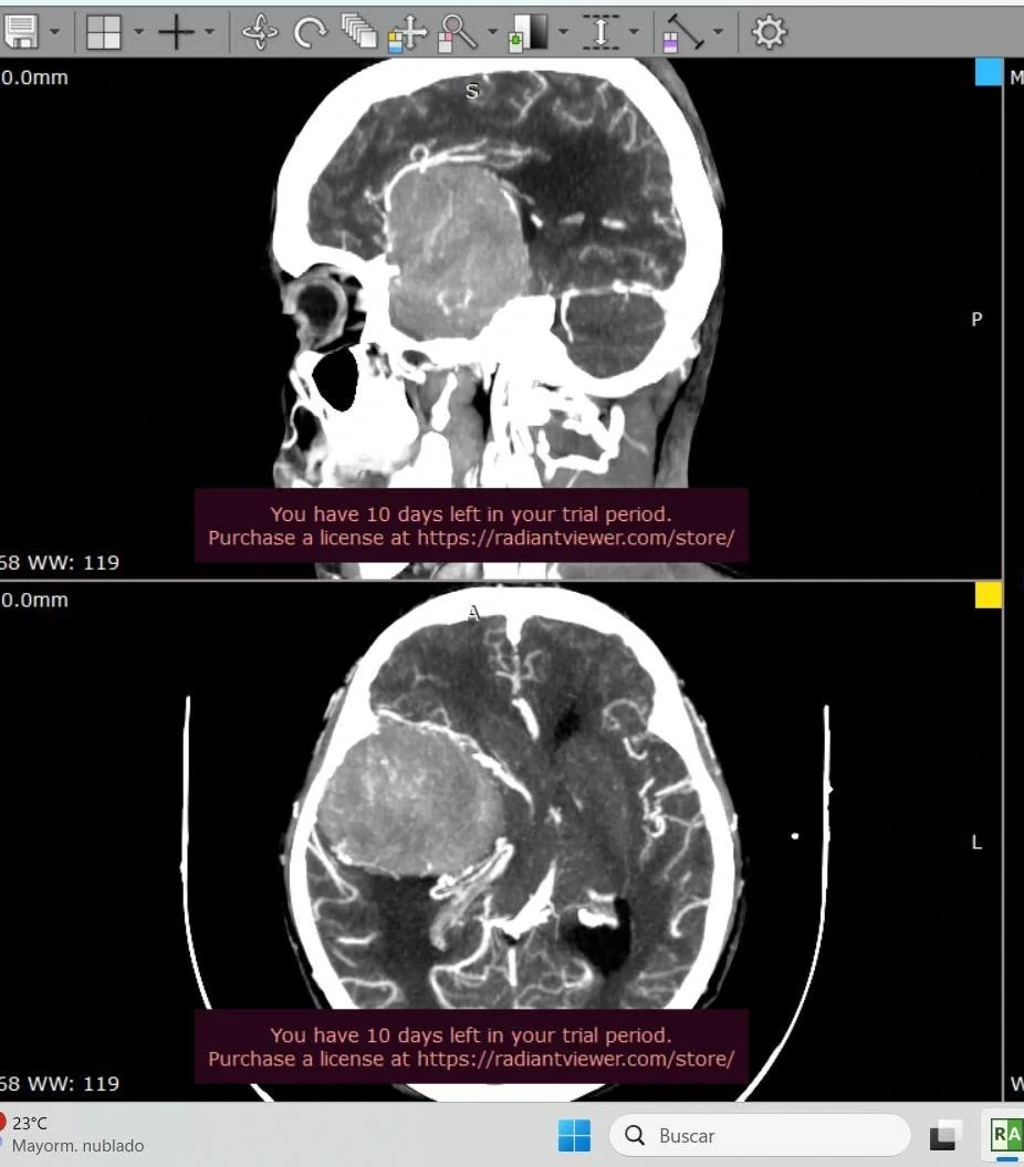 Estudio de angiotomografía cerebral utilizado en la planificación de un caso neuroquirúrgico